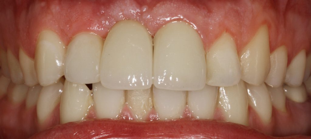 מקרה 2: מצב לאחר הטיפול: שיקום על גבי השתל וכתרים קבועים בשיניים קדמיות בלסת עליונה