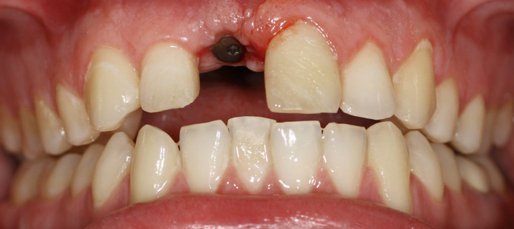 מקרה 2מצב לאחר ההשתלה ושחזורים זמניים בשיניים קדמיות בלסת עליונה